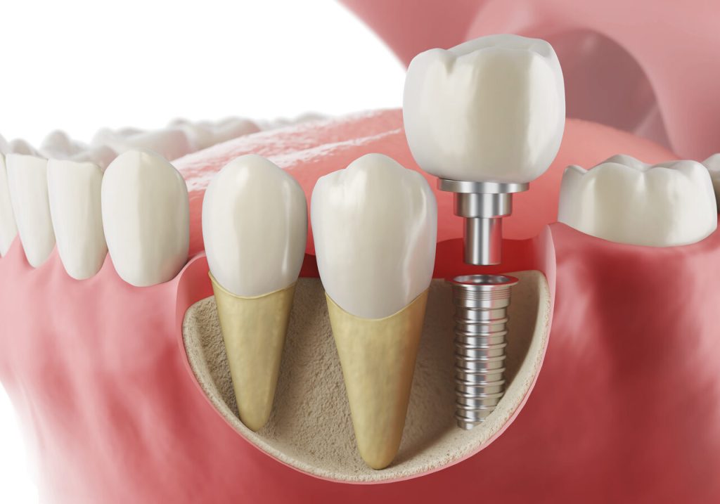 Implantes dentários -Vivace Odontologia Goiânia
