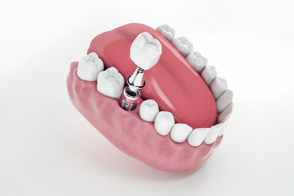 Coroas sobre Implantes-Vivace Odontologia Goiânia