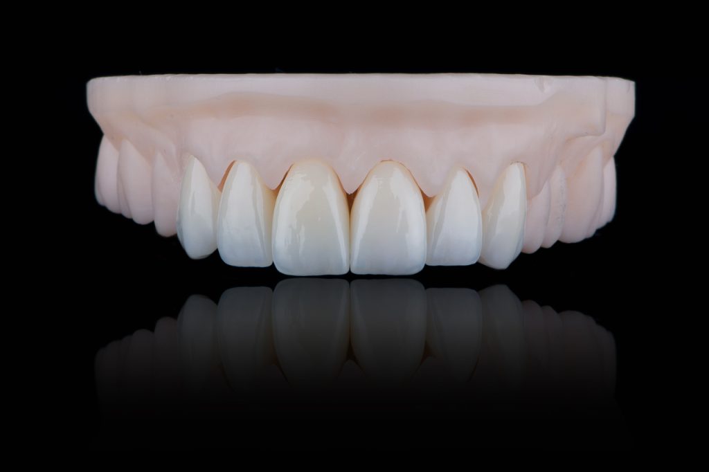 Facetas e coroas de porcelana-Vivace Odontologia Goiânia