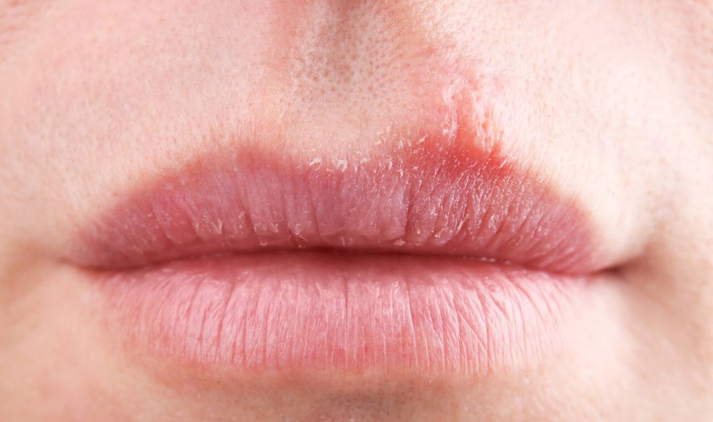 Herpes labial- Vivace Odontologia Goiânia