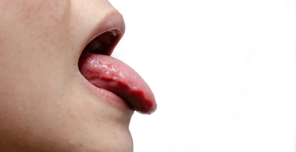 Candidíase oral- Vivace Odontologia Goiânia