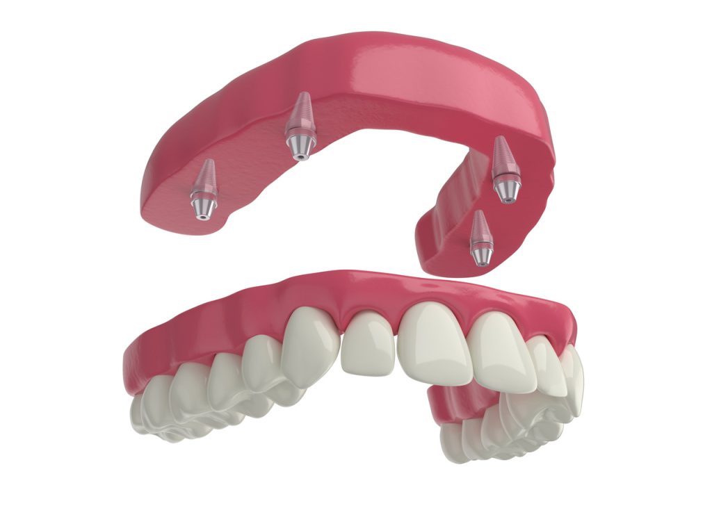 Prótese Overdenture- Vivace Odontologia Goiânia