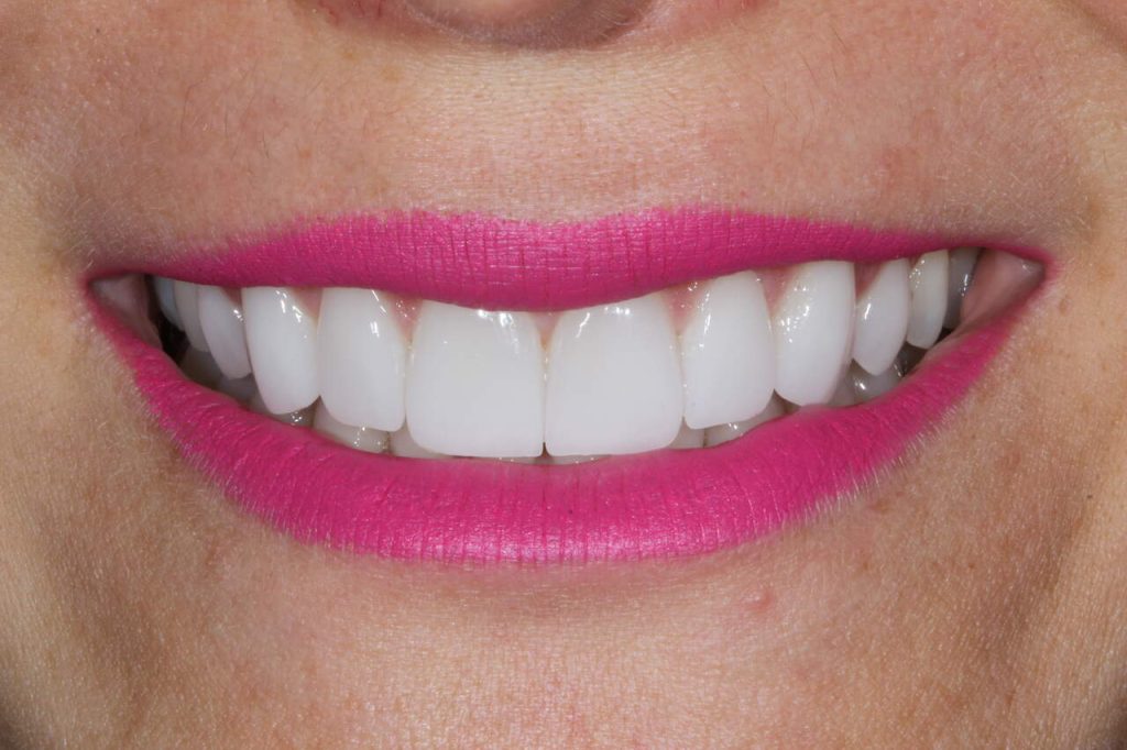 Clareamento dentário-Vivace Odontologia Goiânia