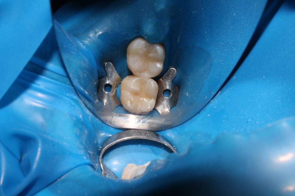 Restaurações Dentárias- Vivace Odontologia Goiânia