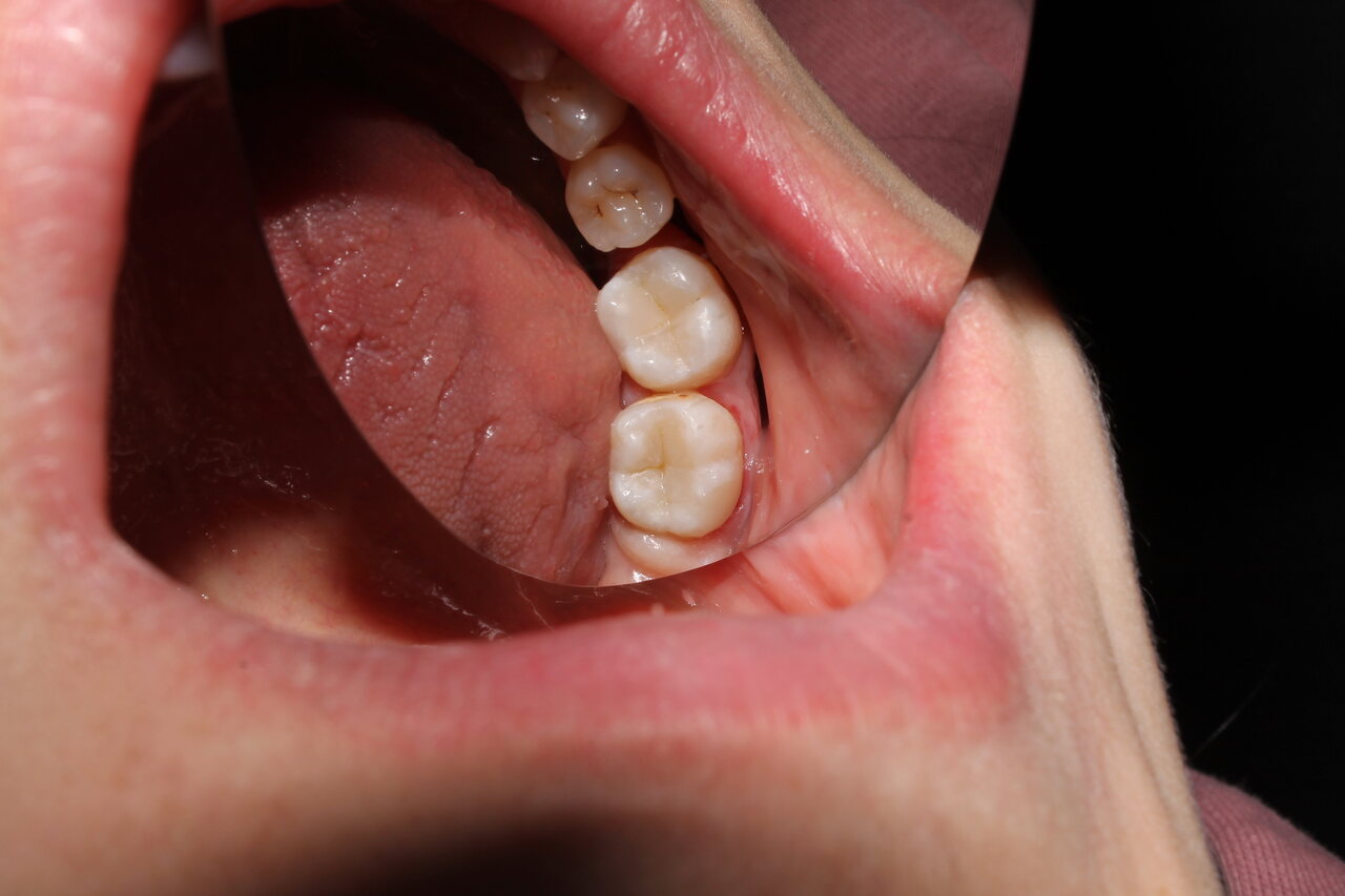 Como saber se preciso trocar as restaurações dos dentes