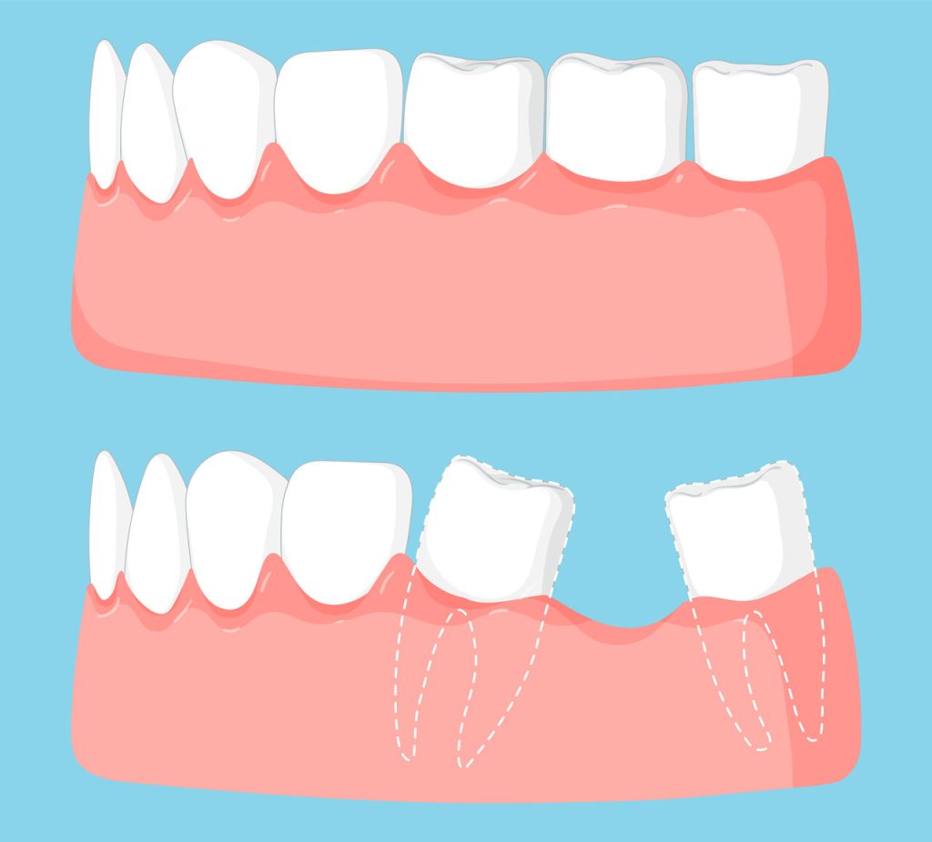 Perdeu um dente O que vem depois pode te surpreender