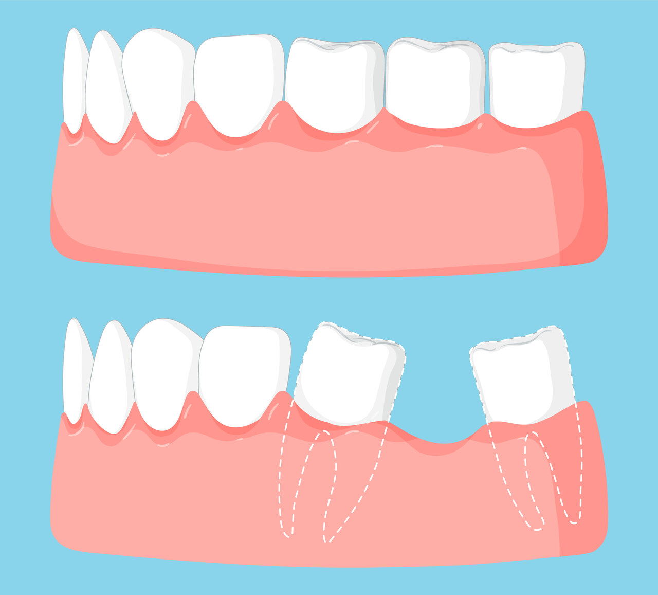 Perdeu um dente O que vem depois pode te surpreender