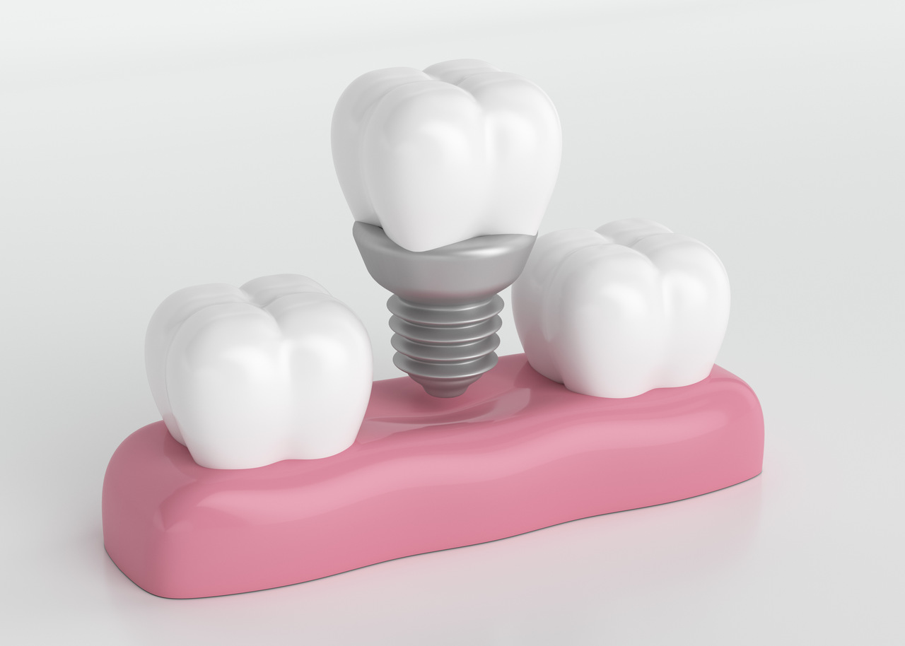 Qual implante dentário é o certo para você Conheça os principais tipos!