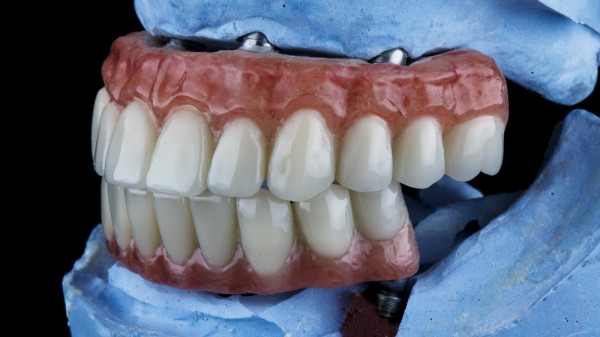 Prótese sobre implantes o fim do medo de sorrir